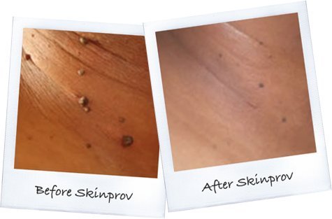 Skinprov Removes 4 Moles or Skin Tags. Low Cost Effective Mole & Skin Tag Remover. All...