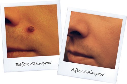 Skinprov Removes 4 Moles or Skin Tags. Low Cost Effective Mole & Skin Tag Remover. All...