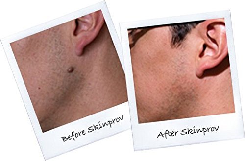 Skinprov Removes 4 Moles or Skin Tags. Low Cost Effective Mole & Skin Tag Remover. All...