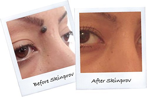 Skinprov Removes 4 Moles or Skin Tags. Low Cost Effective Mole & Skin Tag Remover. All...